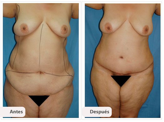 Cirugía Post Bariátrica: Caso 4