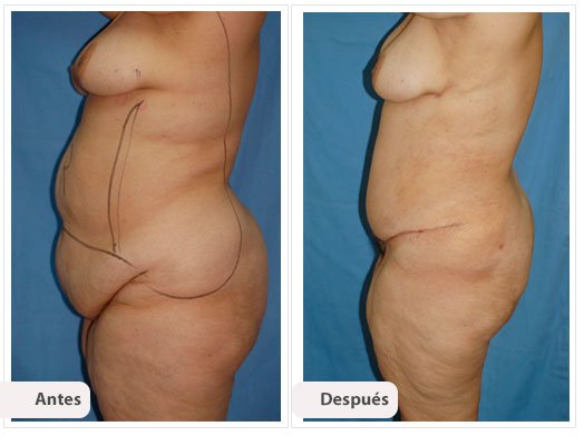 Cirugía Post Bariátrica: Perfil Caso 4