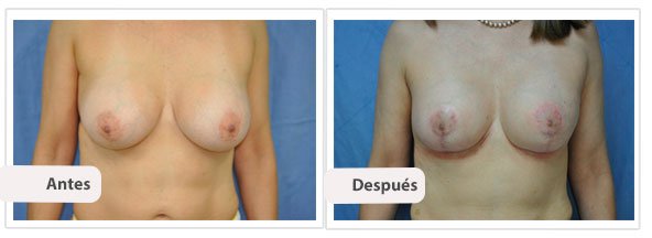 Mastopexia T Invertida: Caso 1