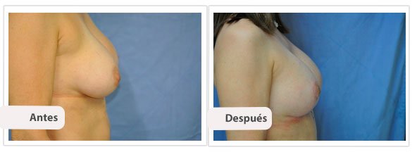 Mastopexia T Invertida: Perfil Caso 1