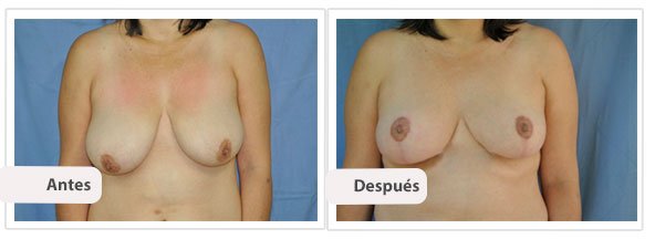 Mastopexia T Invertida: Caso 2