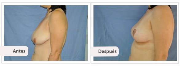 Mastopexia T Invertida: Perfil Caso 2