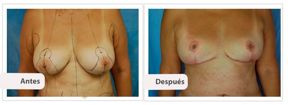 Mastopexia T Invertida: Caso 3