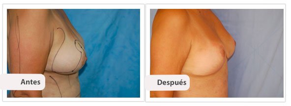 Mastopexia T Invertida: Perfil Caso 3