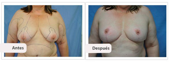 Mastopexia T Invertida: Perfil Caso 4