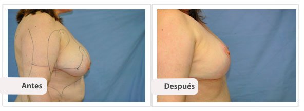 Mastopexia T Invertida: Perfil Caso 4