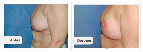 Mastopexia T Invertida: Perfil Caso 5