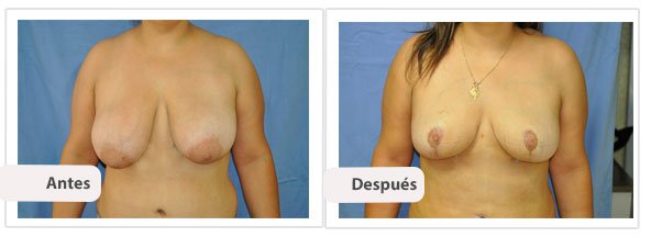 Mastopexia T Invertida: Caso 6