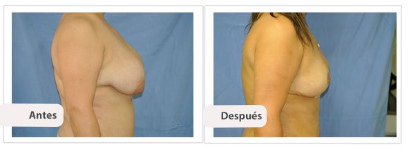 Mastopexia T Invertida: Perfil Caso 6