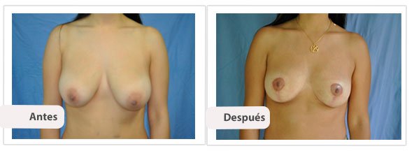 Mastopexia T Invertida: Caso 7