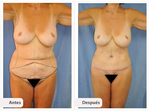 Total Body Lift: Caso 1