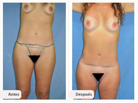 Total Body Lift: Caso 2