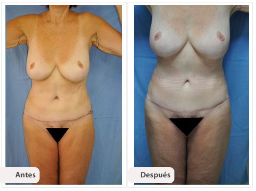 Total Body Lift: Caso 3