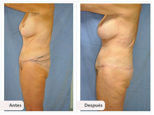 Total Body Lift: Perfil Caso 3