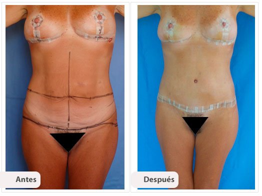 Total Body Lift: Caso 4