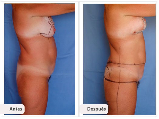 Total Body Lift: Perfil Caso 4