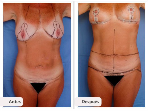 Total Body Lift: Caso 5