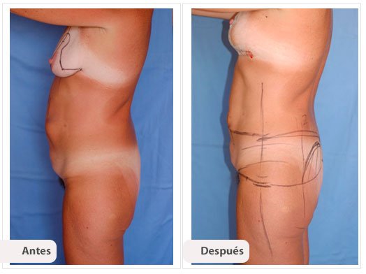 Total Body Lift: Caso 5