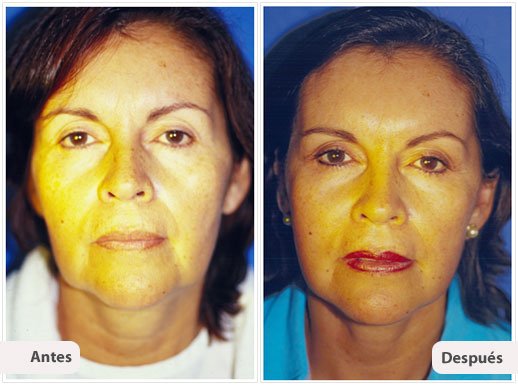 Ritidectomía: Caso 3