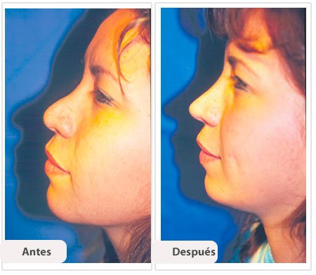 Rinoplastía Secundaria: Caso 5