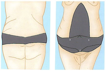 Abdominoplastía mixta (Flor de Lis)