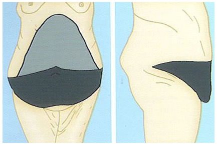 Abdominoplastía Transversal