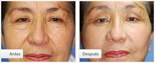Blefaroplastía Inferior