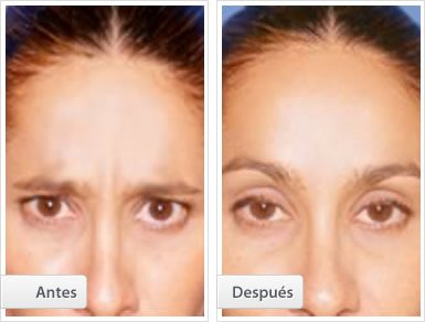 Tratamiento Botox: vista frontal