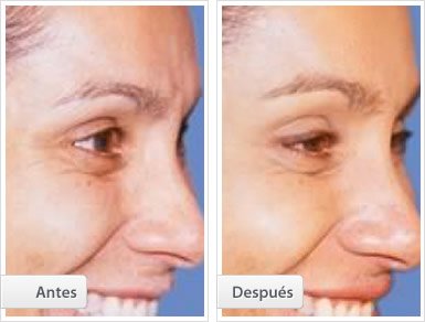 Tratamiento Botox: vista lateral