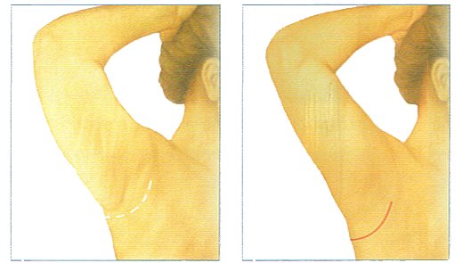 Braquioplastia Axilar