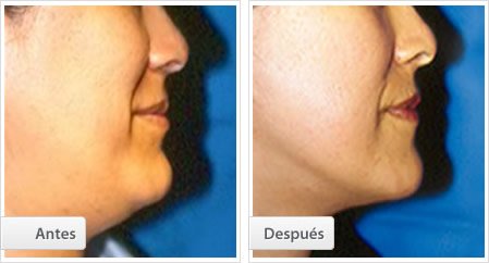 Liposucción de la Papada
