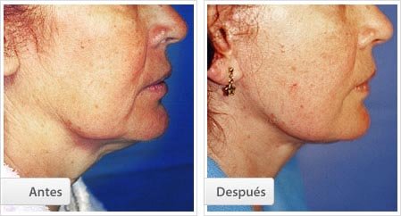 Cervicoplastía Lateral