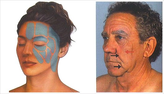 Compartimientos de grasa del rostro