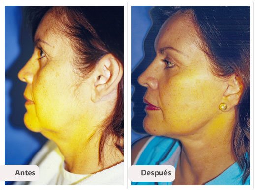 Ritidectomía: perfil Caso 3