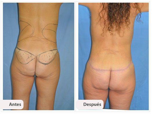 Lifting de Glúteos: Caso 1