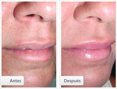 Injerto de Grasa: Labios