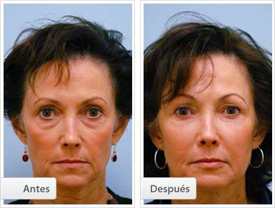 Injerto de Grasa: Facial