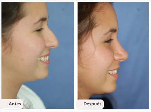 Rinoplastía Primaria: Caso 3
