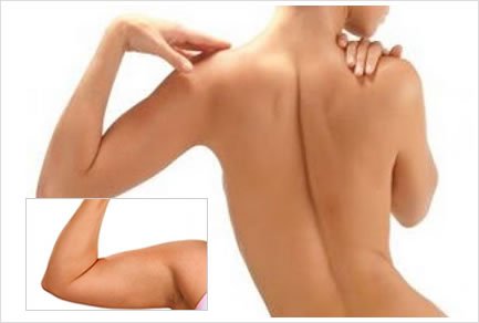 Liposucción de Brazos