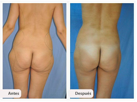 Liposucción de Muslos: Caso 1