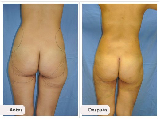Liposucción de Muslos: Caso 2
