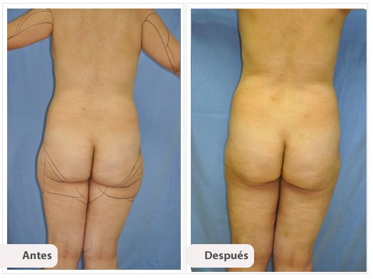 Liposucción de Muslos: Caso 3