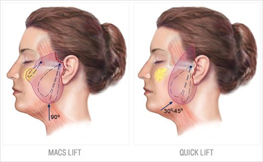 Técnicas: Macs Lift de Tonnard y Quick Lift de Brandy