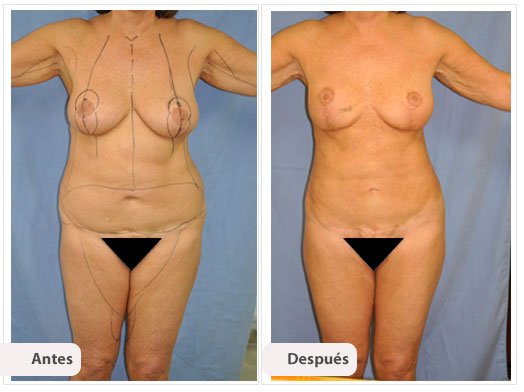 Cirugía Mami Makeover: Caso 1