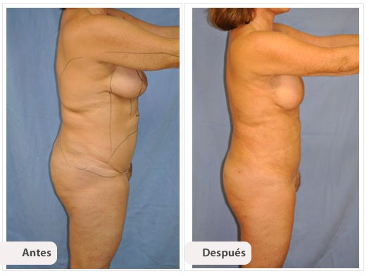 Cirugía Mami Makeover: Perfil Caso 1