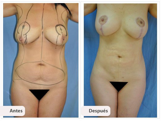 Cirugía Mami Makeover: Caso 2