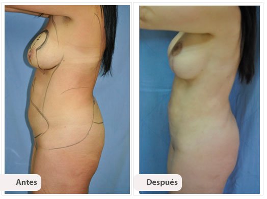 Cirugía Mami Makeover: Perfil Caso 2