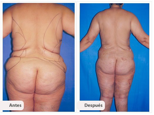 Cirugía Mami Makeover: Caso 3