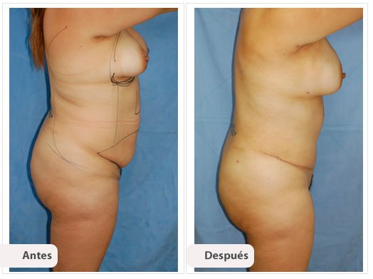 Cirugía Mami Makeover: Perfil Caso 4