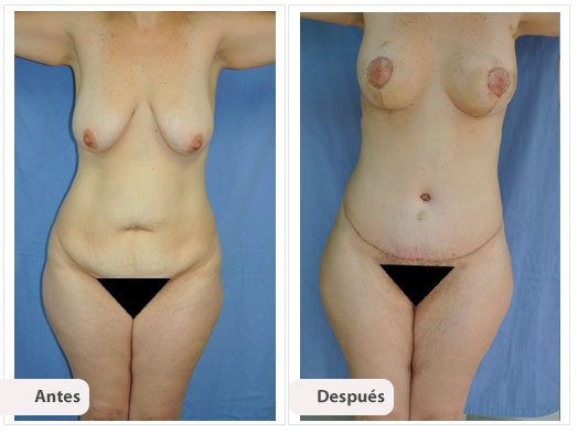 Cirugía Mami Makeover: Caso 5